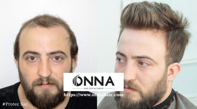 Protez Saç Kullananların Günlük Saç Stil Pratikleri