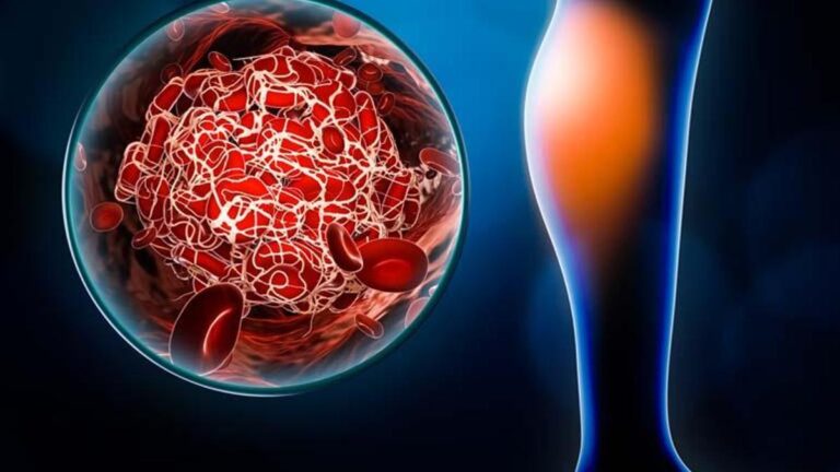 Toplardamar pıhtılarında kritik süre ilk 15 gün