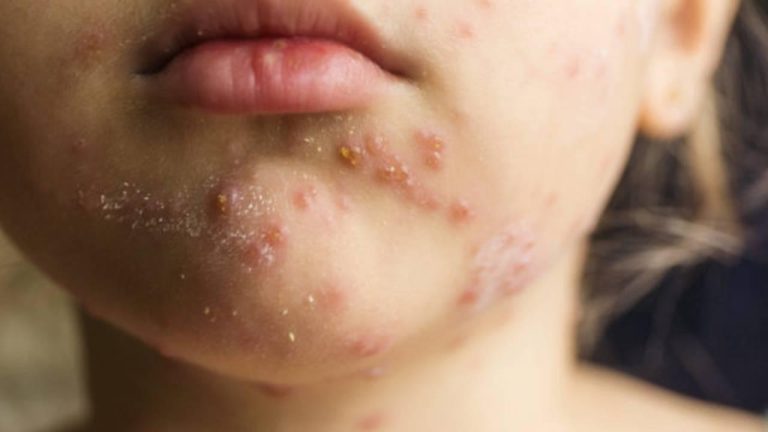 Amerika Birleşik Devletleri'nde 12 eyalete mastil salgın difüzyonu